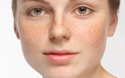 Acne Treatment London: Achieving Clearer Skin with Expert Help