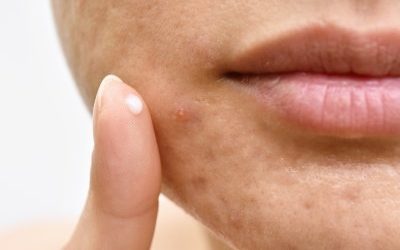 Acne Treatment London