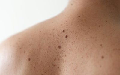 Skin Cancer Treatment London: Expert Care with Dr Tabi Leslie