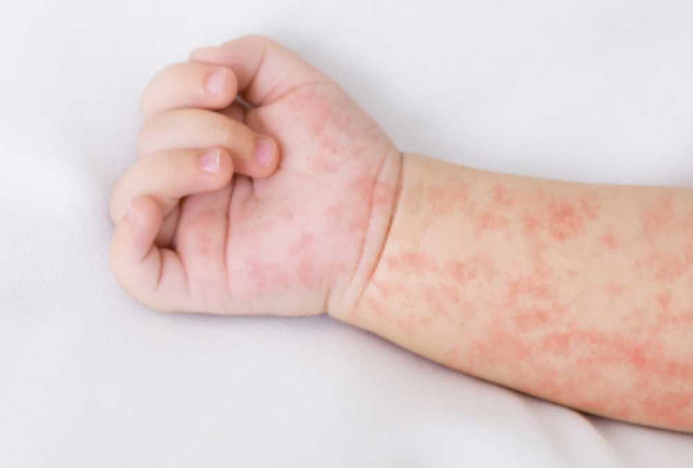 Skin Rash Treatment London
