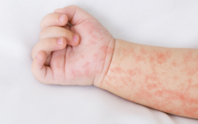 Skin Rash Treatment London