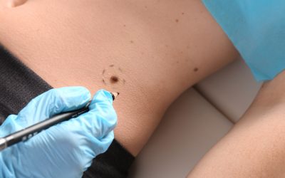 Mole Checks London: Understanding Your Skin and When to Seek Expert Advice