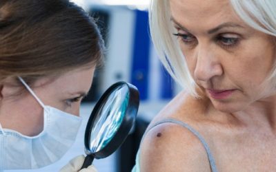 Book in for your Mole Checks London