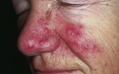 Rosacea Treatment London