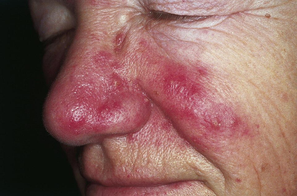 Rosacea Treatment London